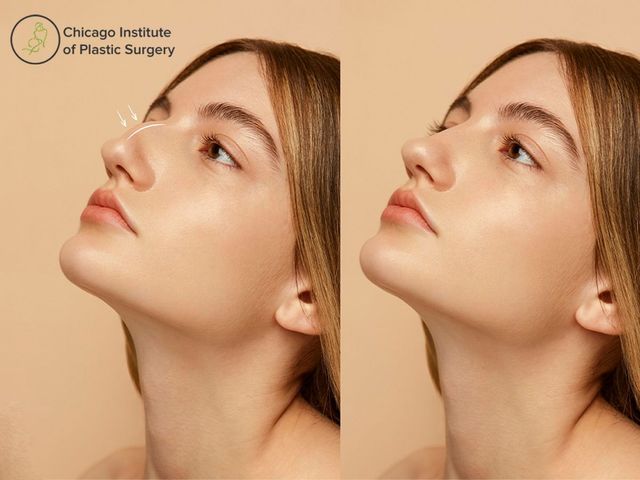 Rhinoplasty deals